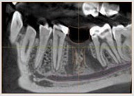 مراحل جراحی و کاشت ایمپلنت دندانی