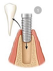 مراحل جراحی و کاشت ایمپلنت دندانی