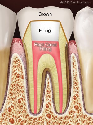 درمان ریشه یا عصب کشی دندان