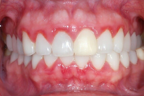 علت دندان درد