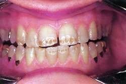 لکه های سفید روی دندان