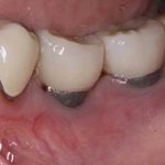 مشکلات ایمپلنت دندانی