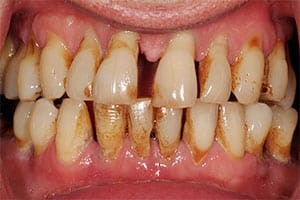 مشکلات ایمپلنت دندانی