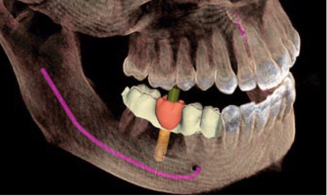 انواع ایمپلنت های دندانی