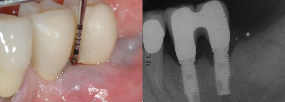 پری ایمپلنتایتیس عفونت ایمپلنت دندانی