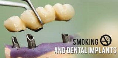 تأثیر سیگار روی شکست ایمپلنت دندانی