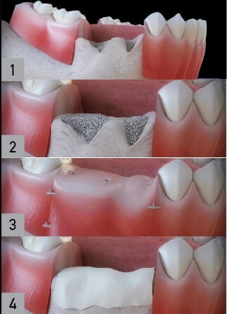 پیوند یا تقویت استخوان قبل از کاشت ایمپلنت های دندانی