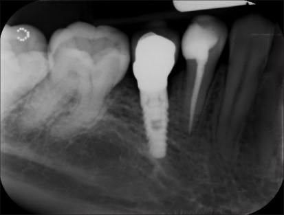 مراحل نصب روکش به ایمپلنت دندانی