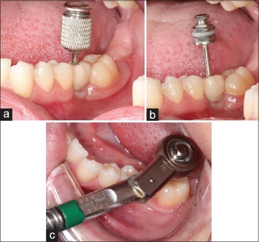 مراحل نصب روکش به ایمپلنت دندانی