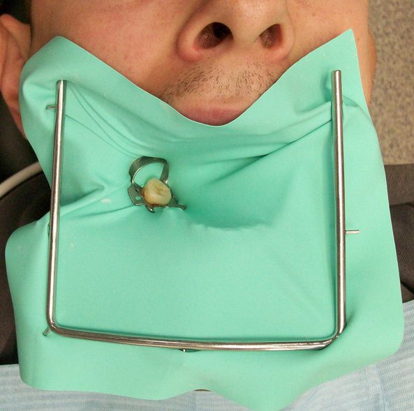 فرایند پر کردن دندان - بخش اول