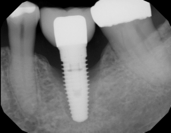علل شکست ایمپلنت های دندانی