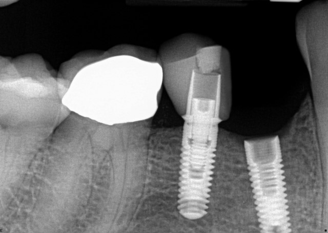 شل شدن ایمپلنت های دندانی