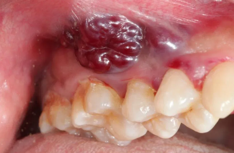 علل برآمدگی داخل دهان