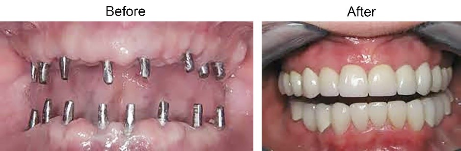 ایمپلنت های دندانی فوری یا یک روزه