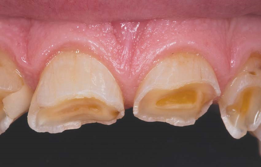 رابطه دندان خراب با مشکلات گوارشی